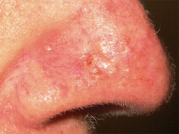 infiltrative basal cell carcinoma