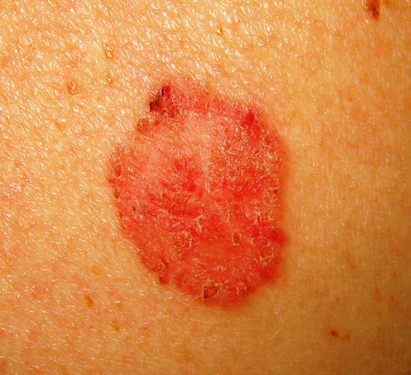 Melanoma Red Spots